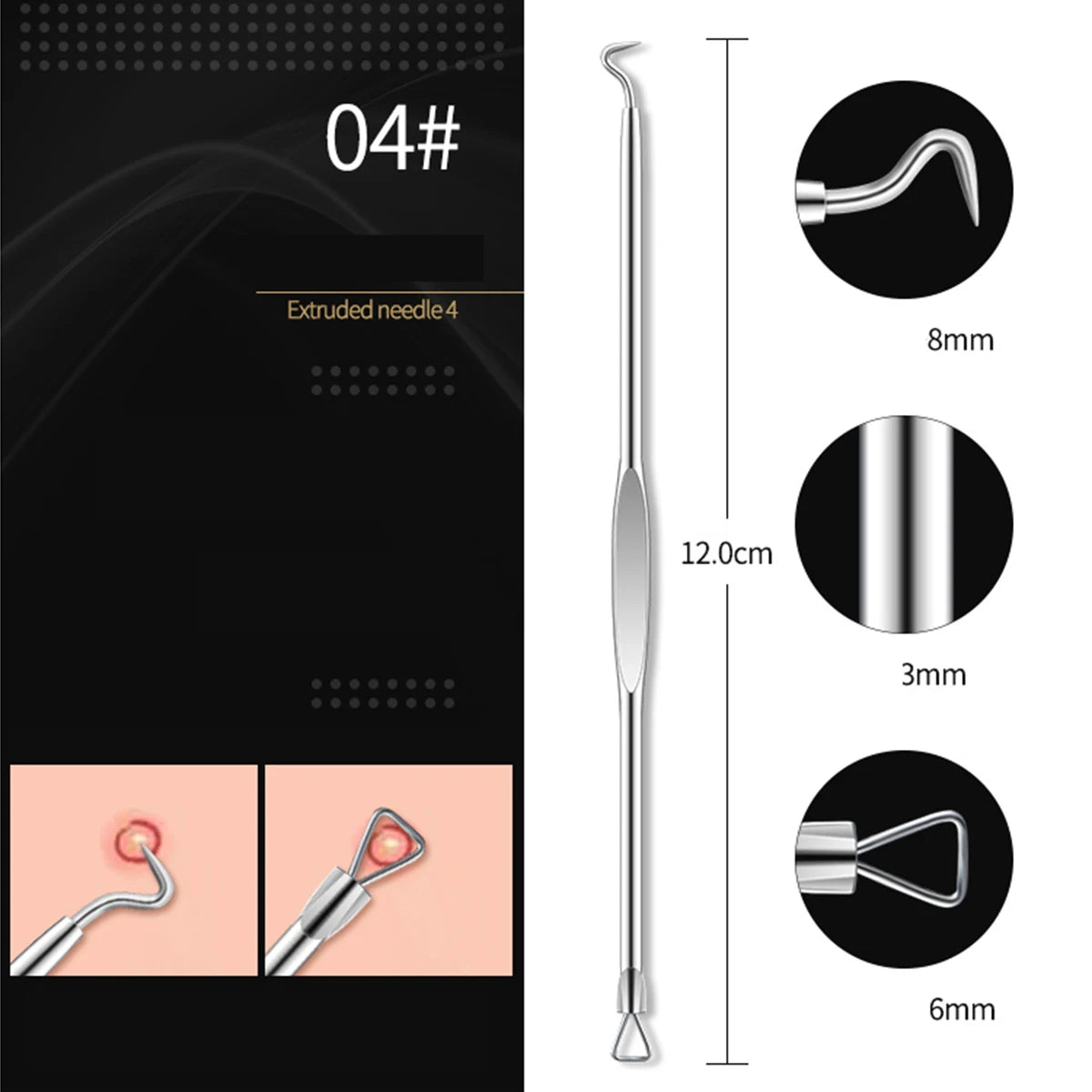 4PCS Blackhead & Pimple Remover Set - Acne Treatment Tools